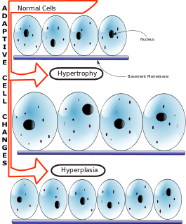 Profile Picture of Hyperplasia - Wikipediaon Wikipedia