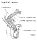 Profile Picture of Inguinal herniaon Wikipedia