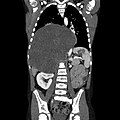 Profile Photo of Ganglioneuromaon Wikipedia