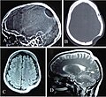 Profile Picture of Gorham's disease - Wikipediaon Wikipedia