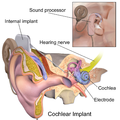 Profile Picture of Cochlear implanton Wikipedia