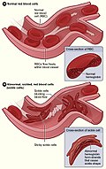 Profile Picture of Sickle cell disease - Wikipediaon Wikipedia