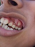 Profile Picture of Malocclusionon Wikipedia
