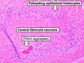 Profile Picture of Rheumatoid noduleon Wikipedia