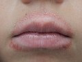 Profile Picture of Lip licker's dermatitison Wikipedia