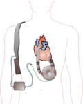 Profile Picture of Ventricular assist device - Wikipediaon Wikipedia