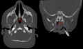 Profile Picture of Choanal atresiaon Wikipedia