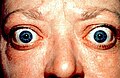 Profile Picture of Graves' disease - Wikipediaon Wikipedia