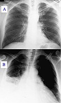 Profile Picture of Ventilator-associated pneumoniaon Wikipedia