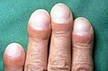 Profile Picture of Pulmonary fibrosison Wikipedia