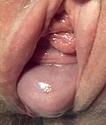 Profile Picture of Pelvic organ prolapseon Wikipedia