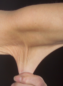 Profile Picture of Ehlers–Danlos syndromeson Wikipedia