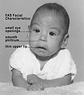 Profile Picture of Fetal alcohol spectrum disorderon Wikipedia