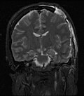 Profile Picture of Intracranial pressure - Wikipedia, the free encyclopediaon Wikipedia