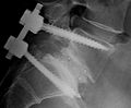 Profile Picture of Spinal fusionon Wikipedia