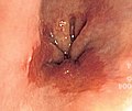 Profile Picture of Barrett's esophagus - Wikipediaon Wikipedia