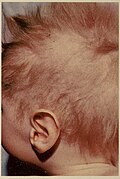 Profile Picture of Menkes disease - Wikipediaon Wikipedia