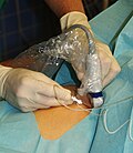 Profile Picture of Nerve block - Wikipediaon Wikipedia