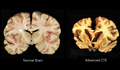 Profile Picture of Chronic traumatic encephalopathyon Wikipedia