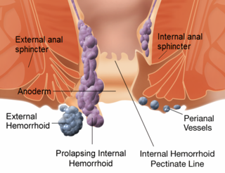 Profile Picture of Hemorrhoidon Wikipedia