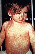 Profile Picture of Measles - Wikipediaon Wikipedia