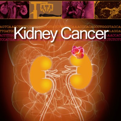 Profile Picture of Kidney Cancer (@KCA_Journal) on Twitter