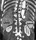 Profile Picture of Artery of Adamkiewicz - Wikipediaon Wikipedia