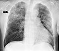 Profile Picture of Pneumonia - Wikipediaon Wikipedia