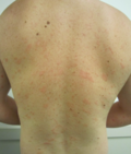 Profile Picture of Pityriasis roseaon Wikipedia