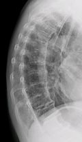 Profile Picture of Diffuse idiopathic skeletal hyperostosison Wikipedia