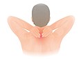 Profile Picture of Neck pain - Wikipediaon Wikipedia