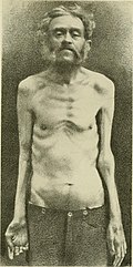Profile Picture of Progressive muscular atrophyon Wikipedia