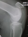 Profile Picture of Patellar tendon rupture - Wikipediaon Wikipedia