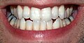 Profile Picture of Permanent teeth - Wikipedia, the free encyclopediaon Wikipedia