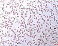 Profile Picture of Paroxysmal nocturnal hemoglobinuriaon Wikipedia