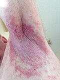 Profile Picture of Hailey–Hailey disease - Wikipediaon Wikipedia