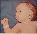 Trisomy 18 - Wikipedia Profile Picture of Trisomy 18on Wikipedia