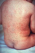 Profile Picture of Exanthem - Wikipediaon Wikipedia