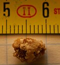 Profile Picture of Kidney stone diseaseon Wikipedia