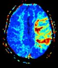 Profile Picture of Perfusion MRIon Wikipedia
