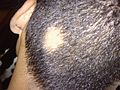 Profile Picture of Alopecia areataon Wikipedia