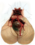 Profile Picture of Intracranial aneurysmon Wikipedia