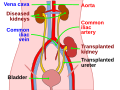 Profile Picture of Kidney transplantation - Wikipedia, the free …on Wikipedia