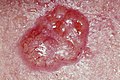 Profile Picture of Skin canceron Wikipedia