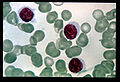 Profile Picture of Hairy cell leukemia - Wikipedia, the free encyclopediaon Wikipedia