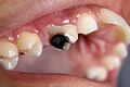 Profile Picture of Tooth decay - Wikipediaon Wikipedia