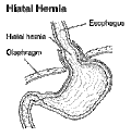 Profile Picture of Hiatal herniaon Wikipedia