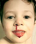 Profile Picture of Nosebleed - Wikipediaon Wikipedia