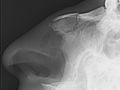 Profile Picture of Nasal fractureon Wikipedia