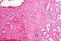 Profile Photo of Renal oncocytomaon Wikipedia